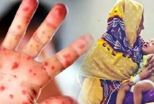 দেশে হামের ভয়াবহতা বাড়ছেই, মৃতের সংখ্যা ৫৬০