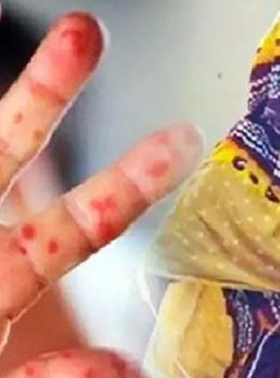 দেশে হামের ভয়াবহতা বাড়ছেই, মৃতের সংখ্যা ৫৬০