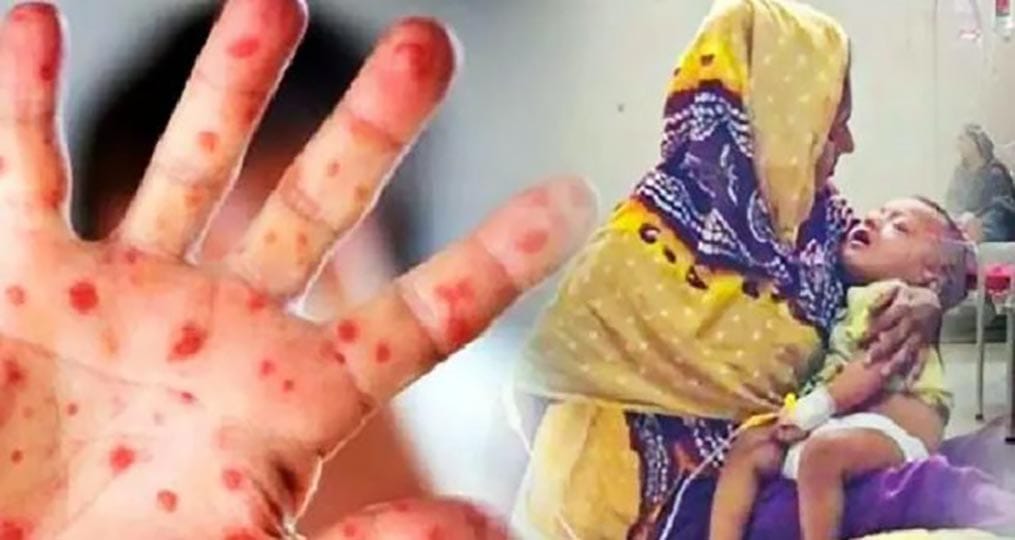 দেশে হামের ভয়াবহতা বাড়ছেই, মৃতের সংখ্যা ৫৬০